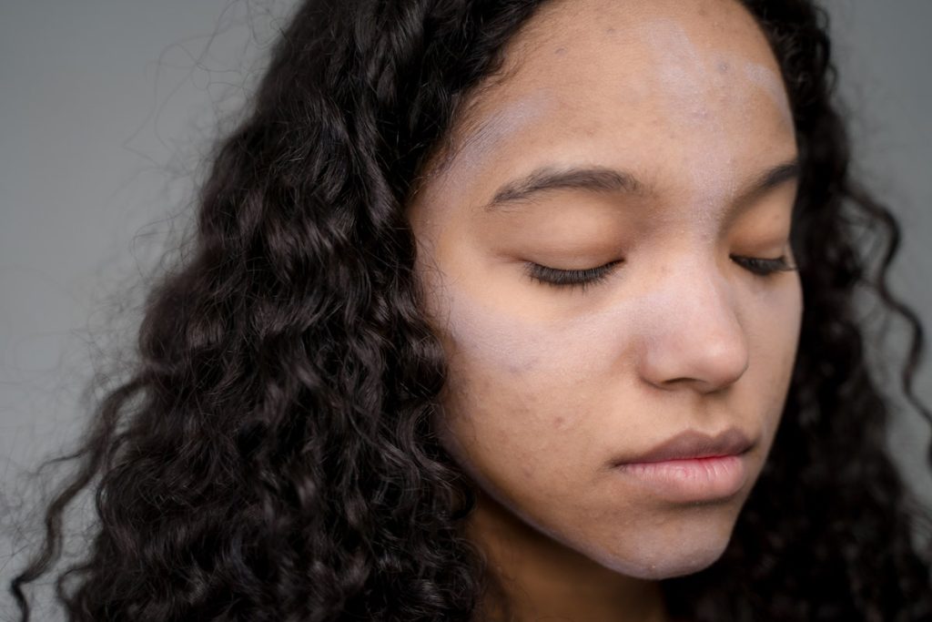 a woman with skin problem on her face