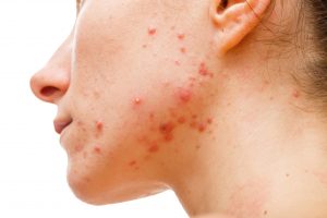 Acne in a woman
